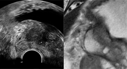 Prostate AutoCalibr 
