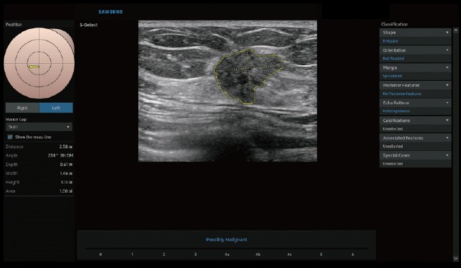 Samsung RS85 S-Detect Breast