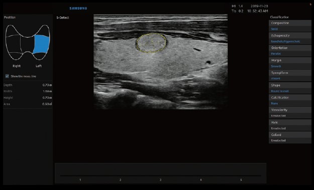 Samsung RS85 S-Detect Thyroid