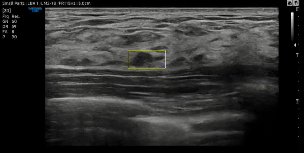 Samsung RS85 LiveBreast Assist